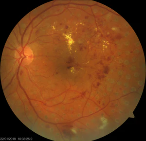 Диабетическая ретинопатия