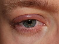 Blepharitis.JPG