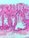 Sessile serrated adenoma3.jpg