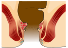 Piles Grade 1.svg