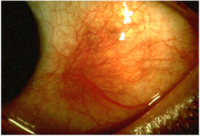 Scleritis.png