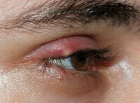 Stye02.jpg