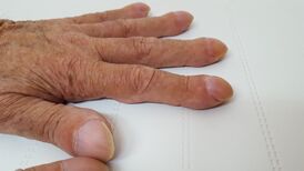 Clubbing fingers 2.jpg