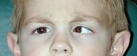 Esotropia-uncorrected.jpg