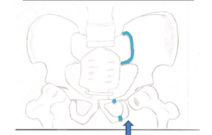 This fracture is best viewed anteriorly, while the other fractures are viewed superiorly. The arrow indicates where the force is coming from, and the colored lines indicate where the break occurs.
