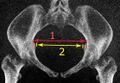 Low-dose CT of transverse diameter of pelvic inlet, and interspinous diameter.jpg