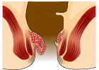Piles Grade 2.svg
