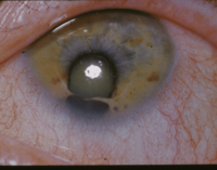 Coloboma.png