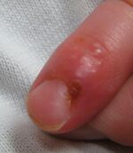 Herpetic whitlow in young child.jpg