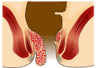 Piles Grade 3.svg