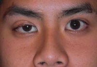 Congenitalptosis.JPG