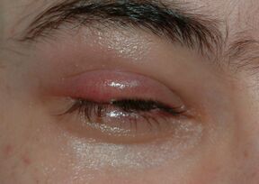 Stye01.jpg