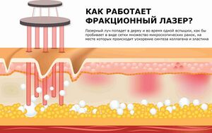 Принцип работы фракционного фототермолиза.jpg