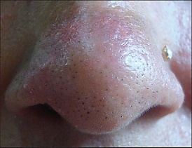 Шиповидный трихостаз.jpg